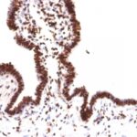 FFPE human ovarian carcinoma sections stained with 100 ul anti-Histone H1 (clone HH1/957) at 1:100. HIER epitope retrieval prior to staining was performed in 10mM Citrate, pH 6.0.